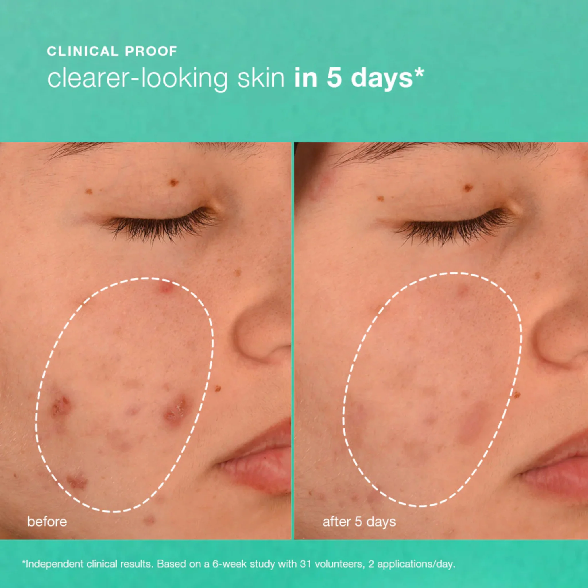 Dermalogica Active Clearing Breakout Biotic Moisturiser - Image 4