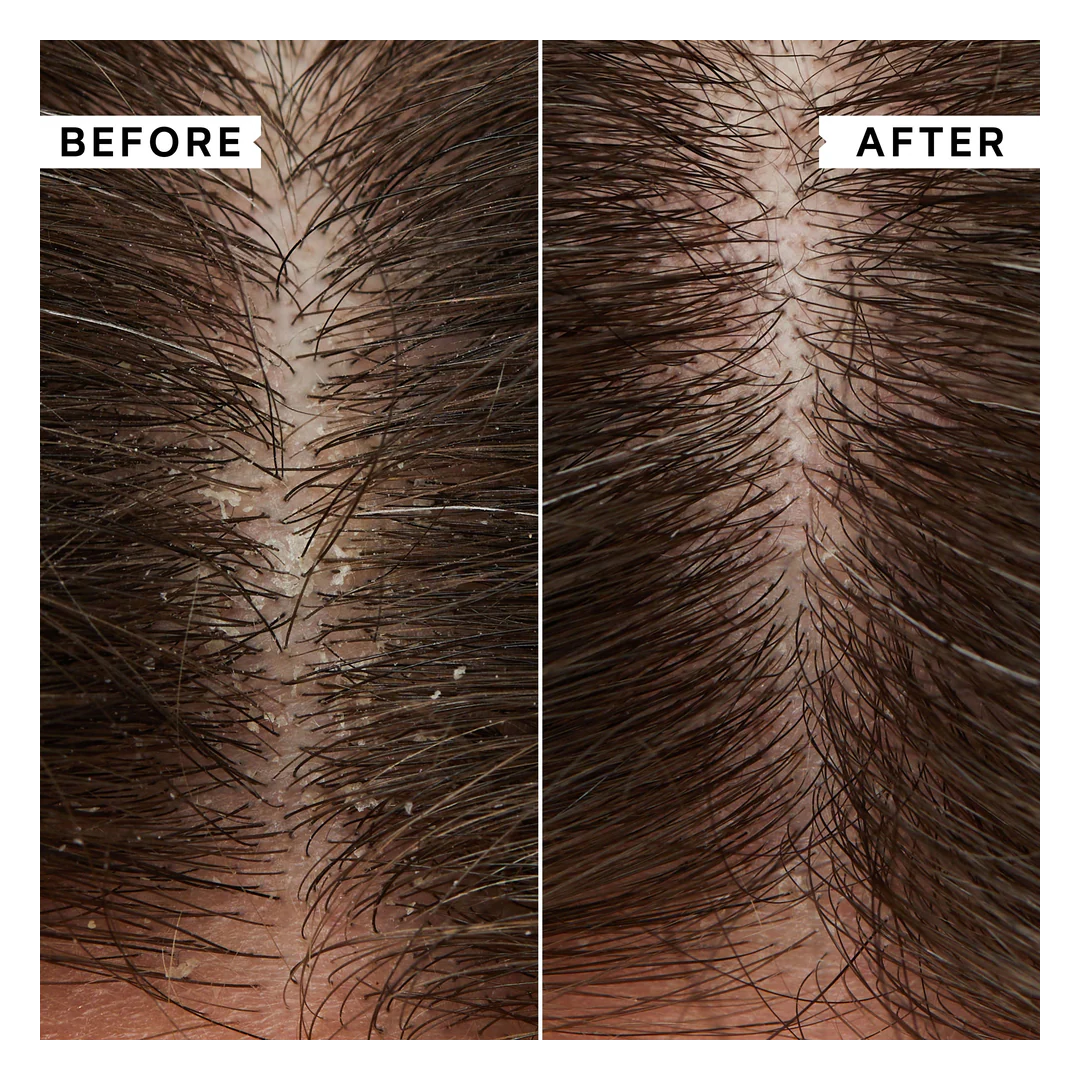 Philip Kingsley Flaky/Itchy Scalp Anti-Dandruff Scalp Mask - Image 4