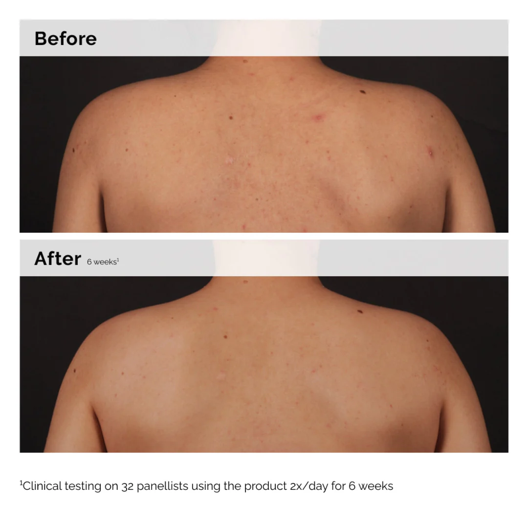 The Ordinary Salicylic Acid 0.5% Body Serum - Image 3