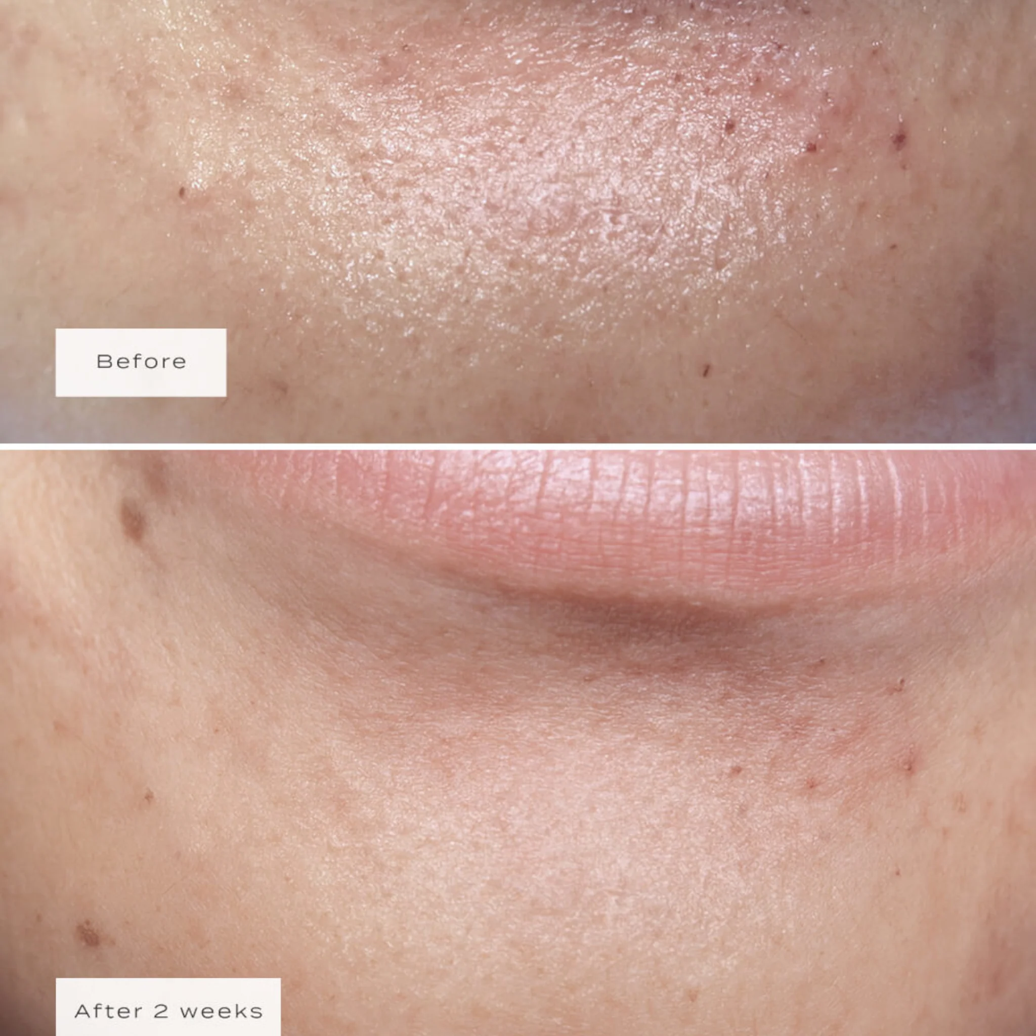 Vue Chin Patches - Image 5