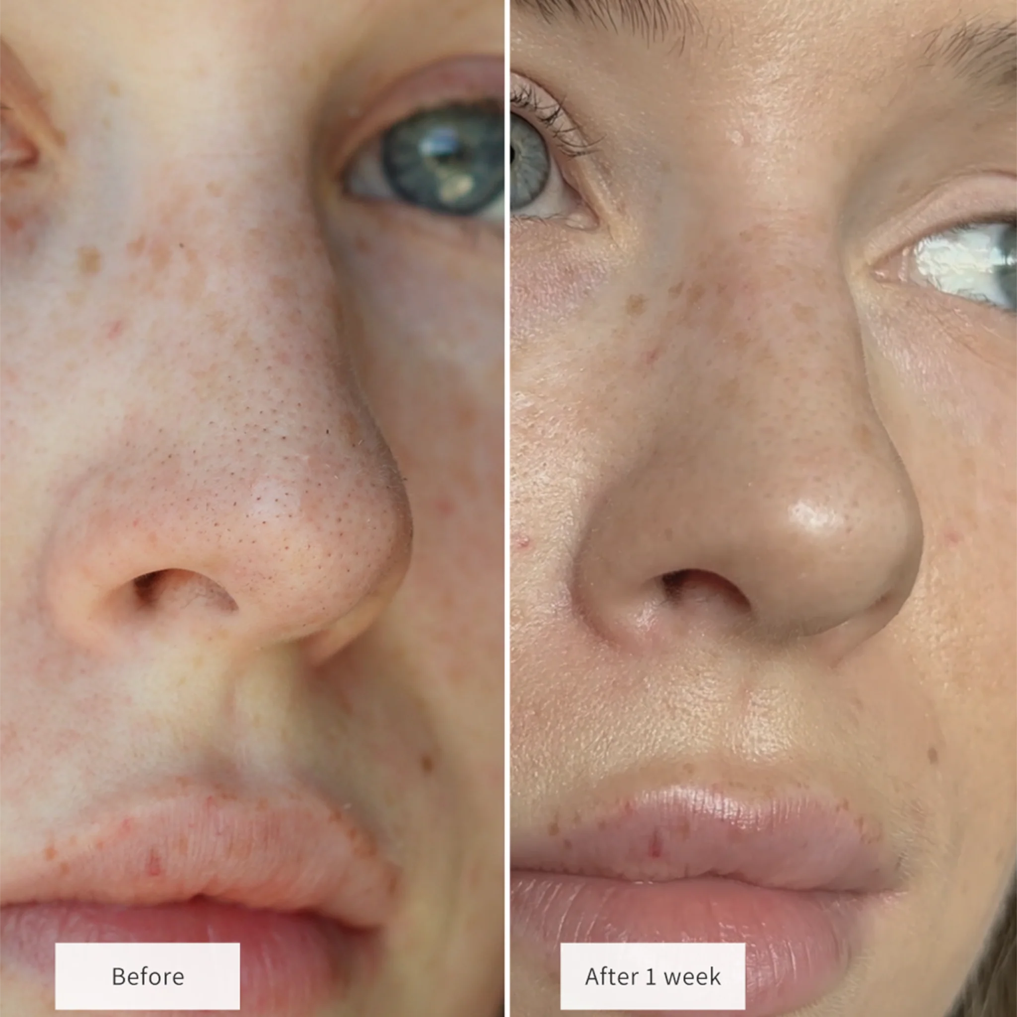 Vue Nose Patches - Image 8
