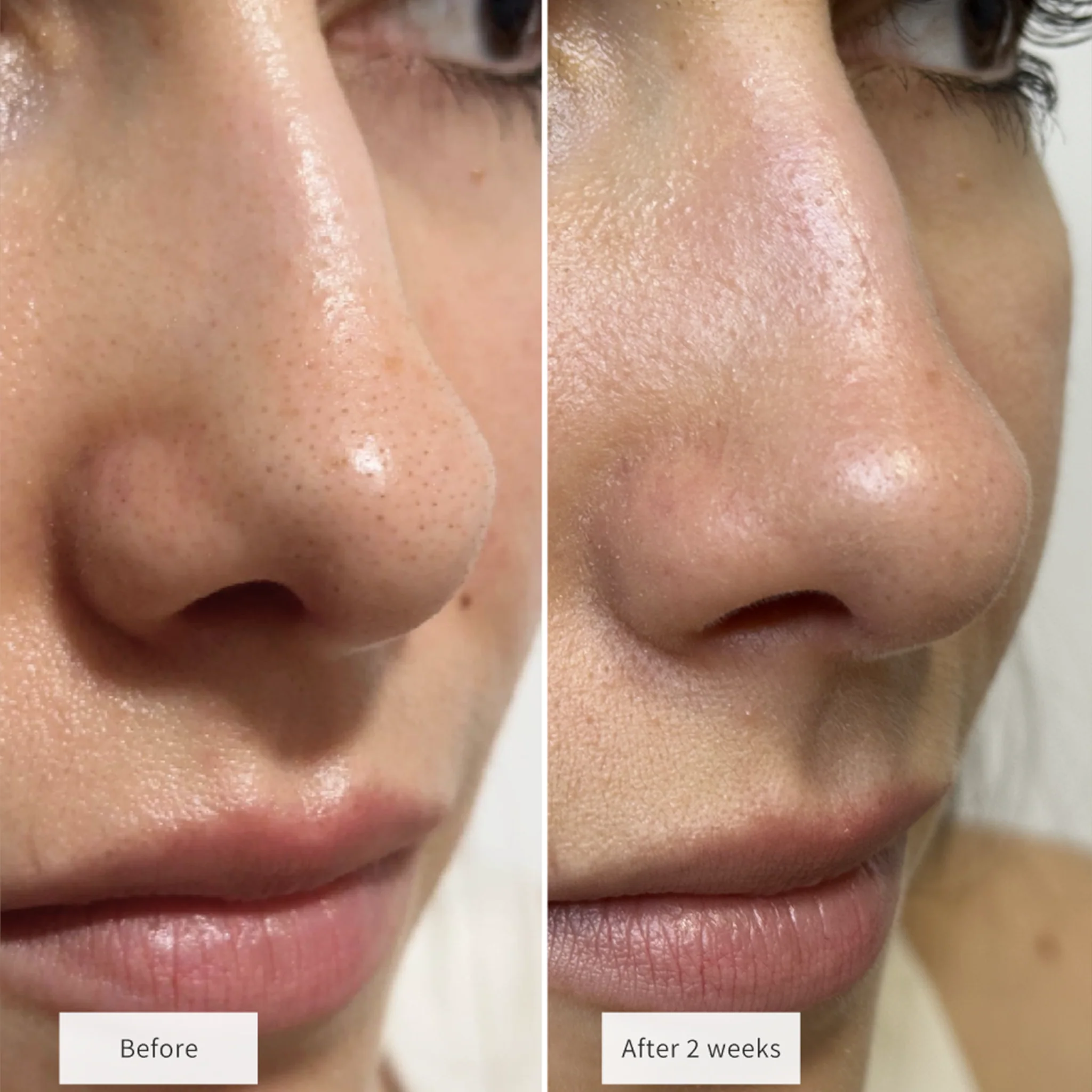 Vue Nose Patches - Image 9